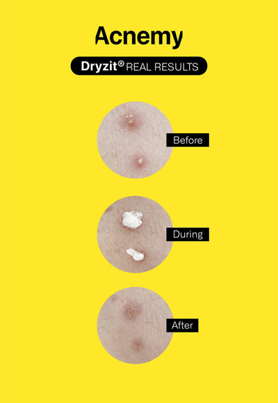 Dryzit® before - after