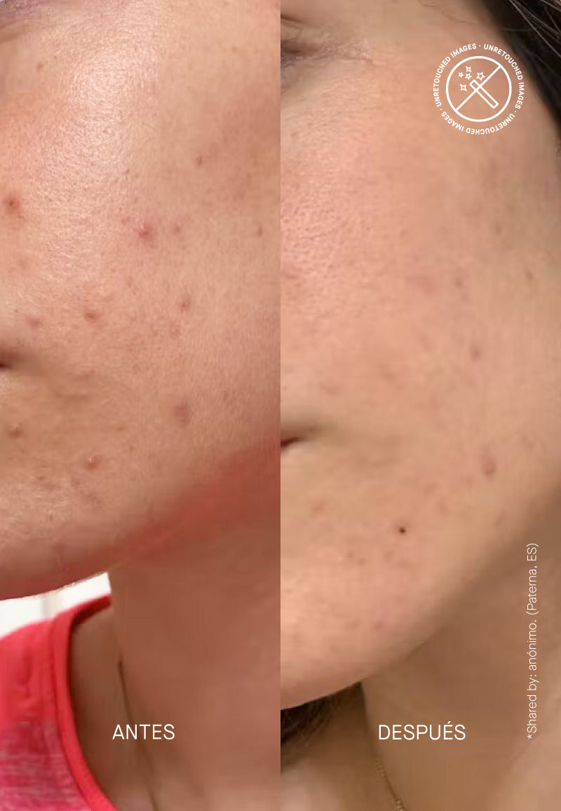 PIE Acne Red Spot Fading Treatment