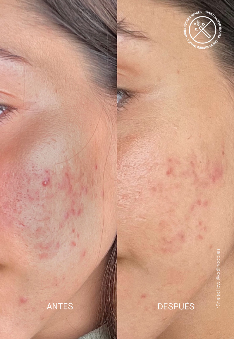 15% Azelaic Acid Treatment I AZID I Theramid – NICHE BEAUTY LAB