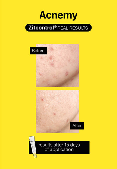 Zitcontrol® before - after