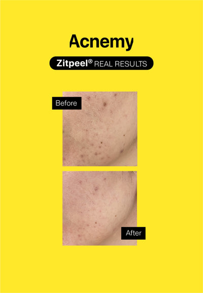 Zitpeel® before after