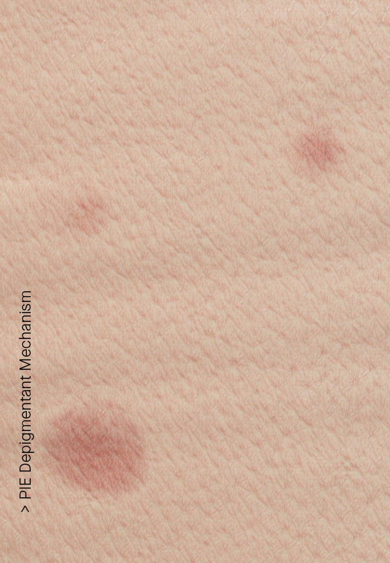 PIE Acne Red Spot Fading Treatment